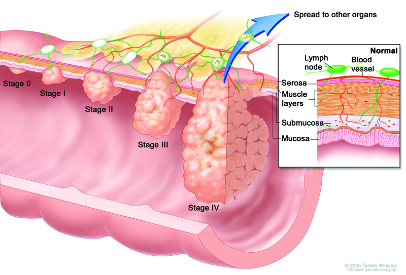 A new study on dietary lifestyle and cancer