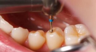 Procedure for Filling a Dental Cavity